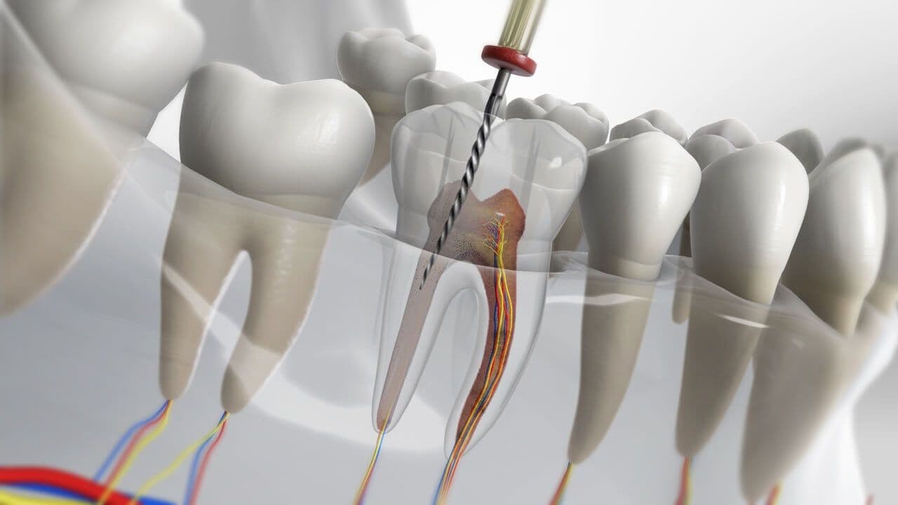 Endodontie à Sassenage - Dr Heni KHELIFI - Sassenage, proche de Fontaine et Grenoble