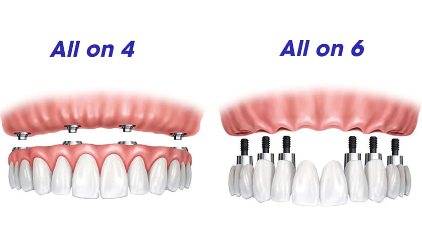 Technique All-on-4/6