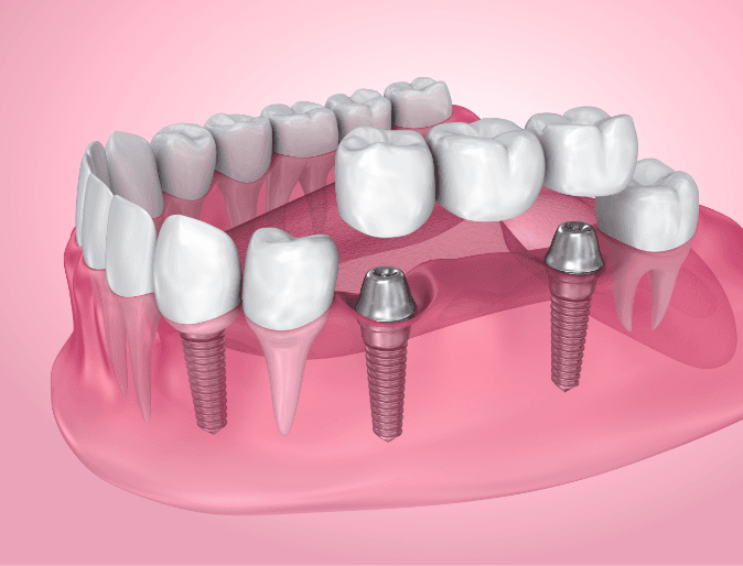 Types de prothèses sur implant