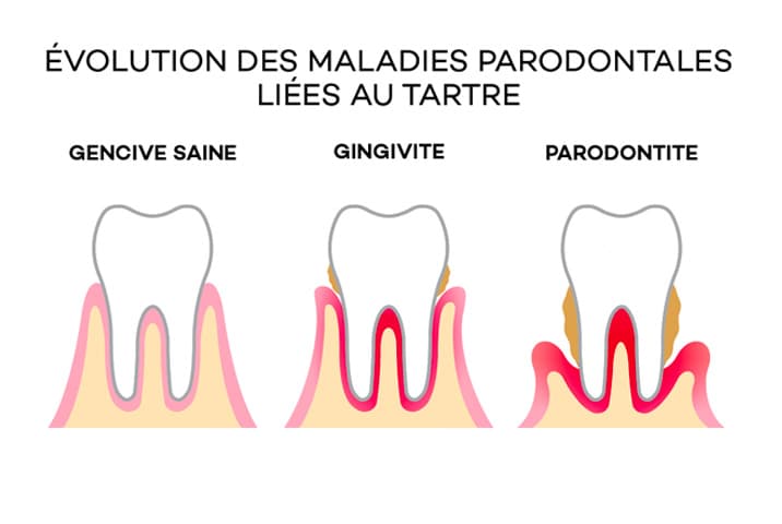 Évolution de la maladie parodontale