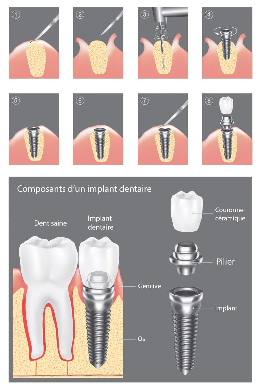 Étapes de la pose d'implant dentaire