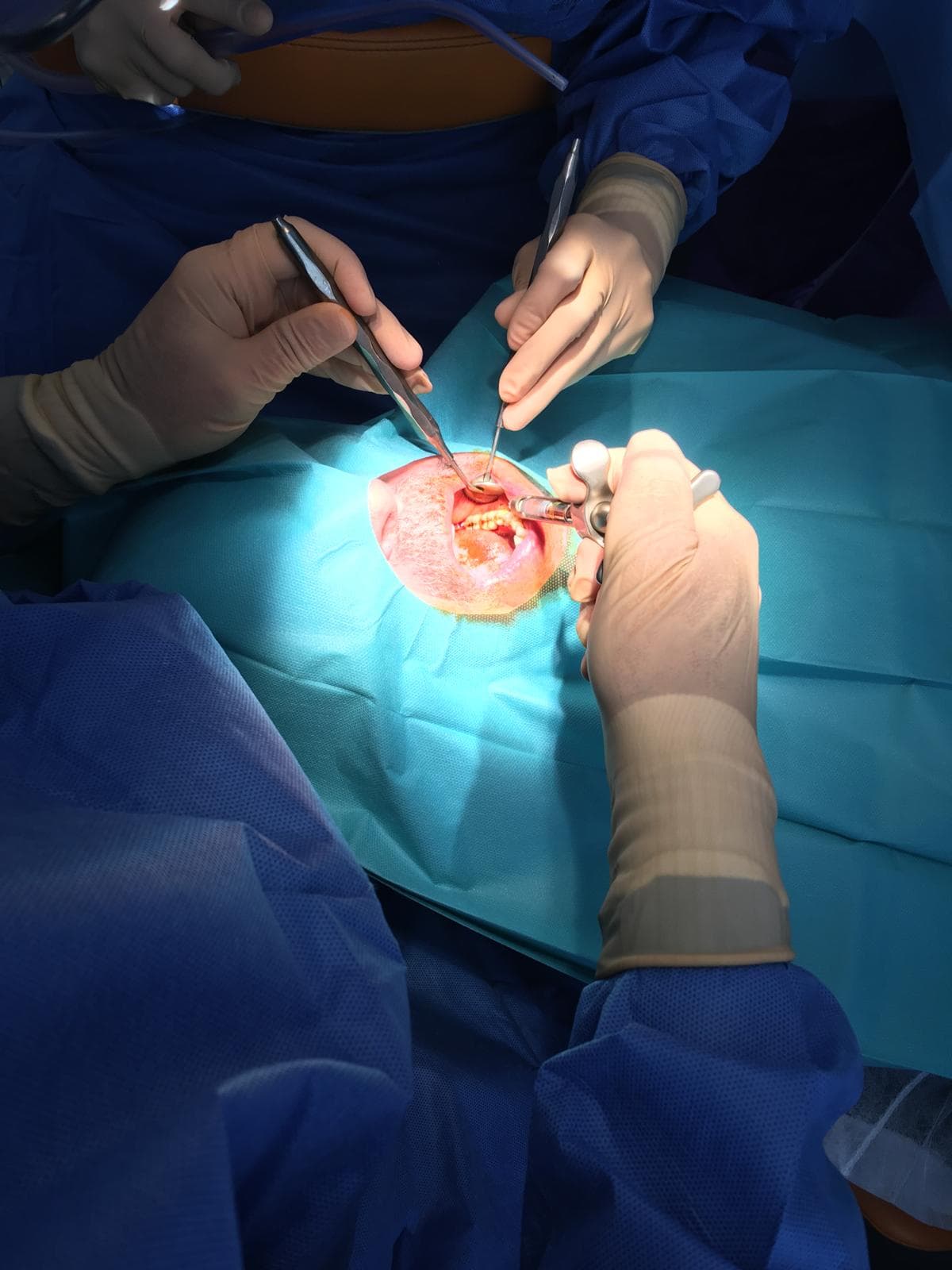 Chirurgie orale au Cabinet Dentaire Dr Heni KHELIFI à Sassenage - Équipement moderne et techniques mini-invasives